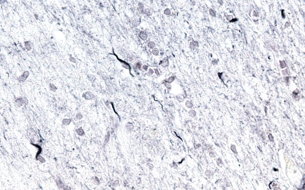 3C5 Argyrophilic Grain Dementia (Case 3) L23 Gallyas 60X WM 4