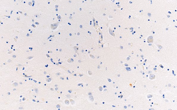 3D3 Argyrophilic Grain Dementia (Case 3) L23 BAP 40X