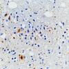 4A2 Argyrophilic Grain Dementia & Hippocampal sclerosis (Case 4) PHF1 40X