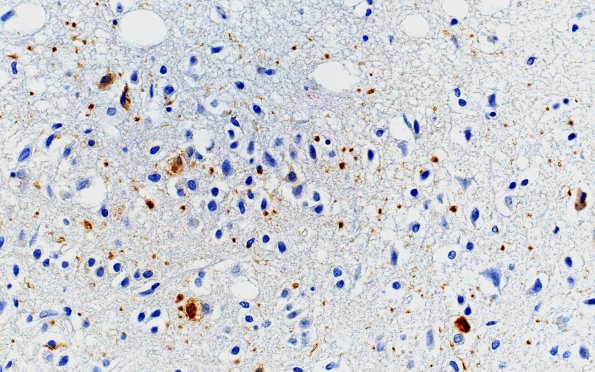 4A2 Argyrophilic Grain Dementia & Hippocampal sclerosis (Case 4) PHF1 40X