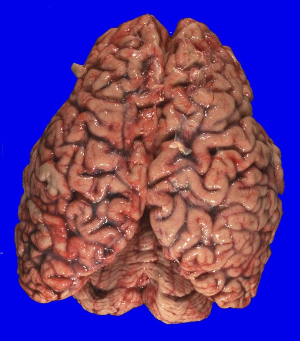 5A1 (Case 5) Gross_1