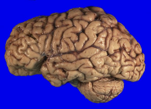 5A2 (Case 5) Gross_2