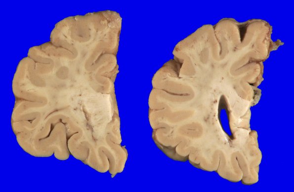 5A3 (Case 5) Gross_3