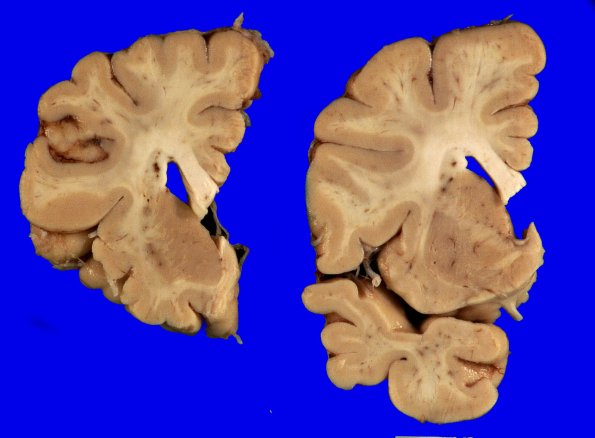 5A4 (Case 5) Gross_4
