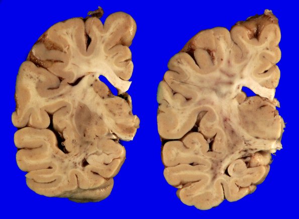 5A5 (Case 5) Gross_5