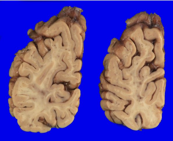 5A6 (Case 5) Gross_6