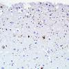 5B1 Argyrophilic Grain Disease (AGD, Case 5) PHF1.jpg