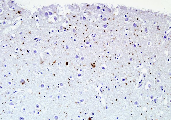 5B1 Argyrophilic Grain Disease (AGD, Case 5) PHF1.jpg