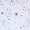 5B2 Argyrophilic Grain Disease (AGD, Case 5) PHF1 3.jpg