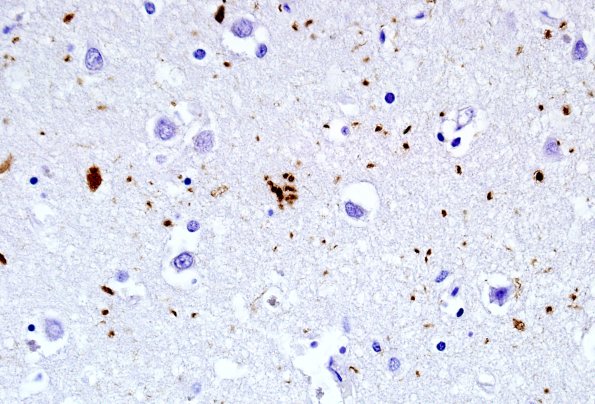 5B2 Argyrophilic Grain Disease (AGD, Case 5) PHF1 3.jpg