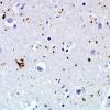 5B3 Argyrophilic Grain Disease (AGD, Case 5) PHF1 2.jpg