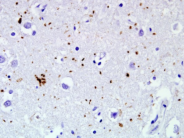 5B3 Argyrophilic Grain Disease (AGD, Case 5) PHF1 2.jpg