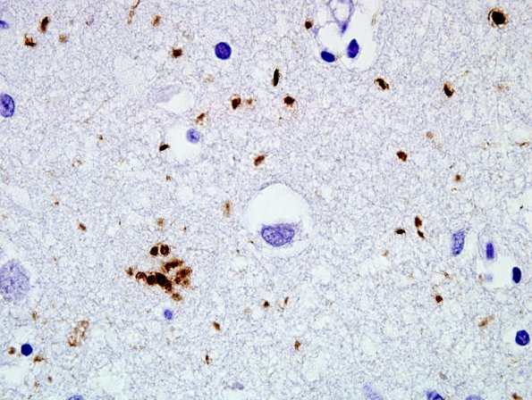 5B4 Argyrophilic Grain Disease (AGD, Case 5) PHF1 100X 1.jpg