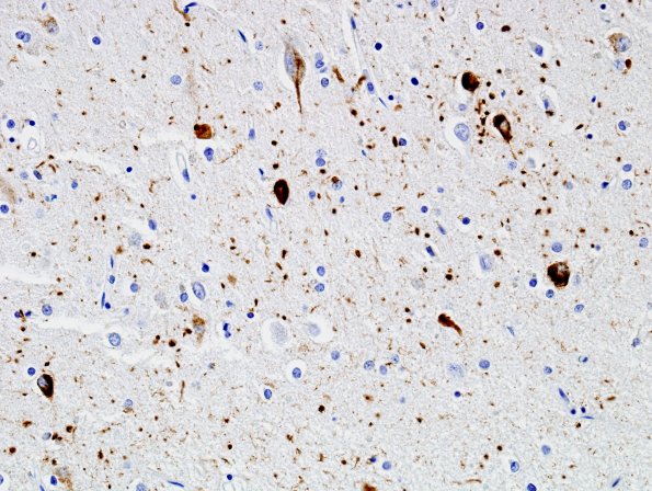6B2 Argyrophilic grains, AGD, entorhinal cortex (Case 6) PHF 4