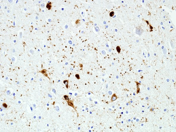 6B3 Argyrophilic grains, AGD, entorhinal cortex (Case 6) PHF 3