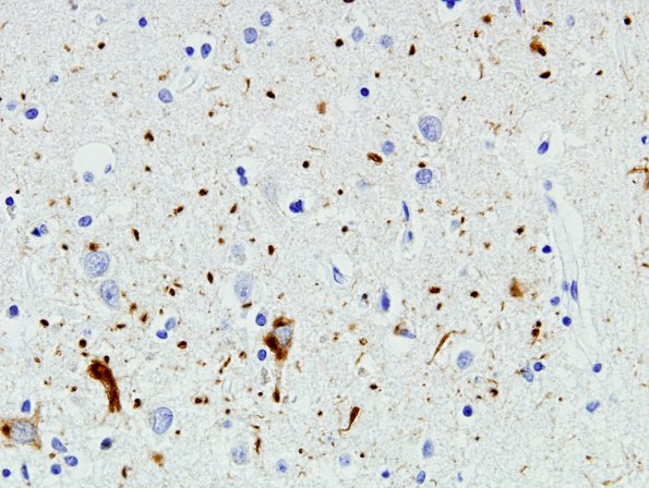 6B5 Argyrophilic grains, AGD, entorhinal cortex (Case 6) PHF 7