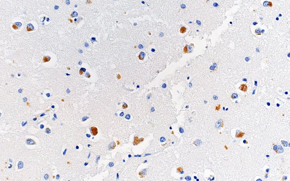 6C Cortical Lewy bodies (Case 6) pSYN L23 40X