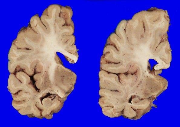 7A2 AGD (Case 7) Gross_2