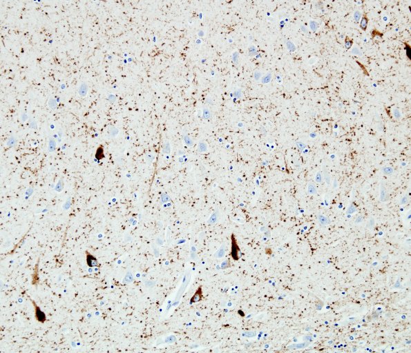 7B3 Argyrophilic grain Dz (AGD) (Case 7) PHF 2