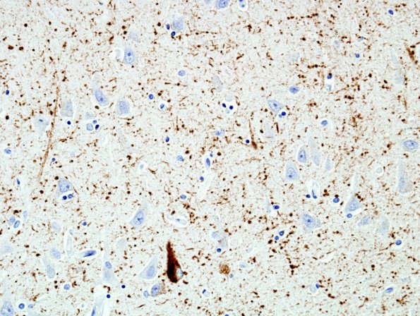 7B4 Argyrophilic grain Dz (AGD) (Case 7) PHF 1