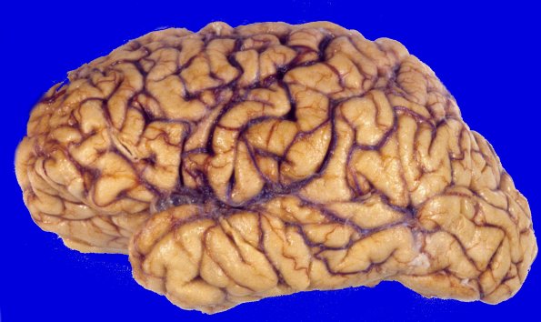 1A1 Corticobasal degeneration (CBD, Case 1) 1