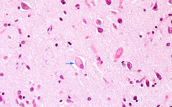 1B3 Corticobasal Degeneration (CBD, Case 1) H&E 3 copy copy.jpg