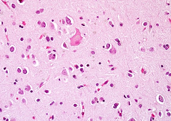 1B4 Corticobasal Degeneration (CBD, Case 1) H&E 4.jpg