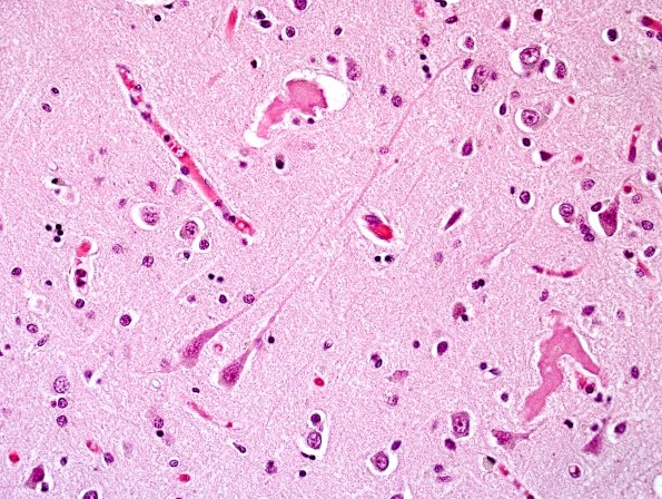 1B7 Corticobasal Degeneration (Case 1) H&E 1.jpg