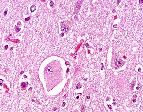 1B9 (Case 1) Neuron, ballooned, CBD H&E