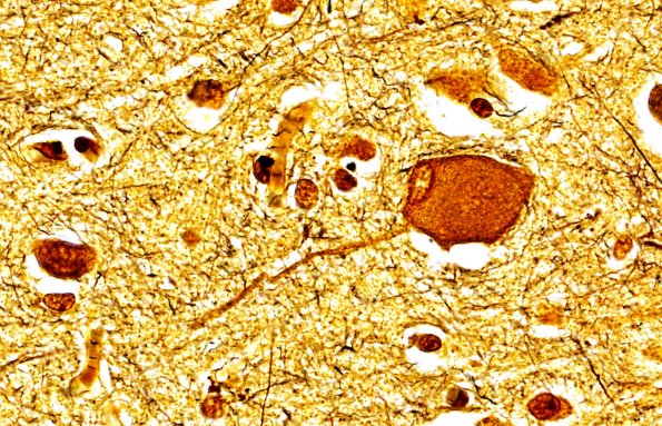 1C2 Corticobasal Degeneration (Case 1) Biels 2.jpg