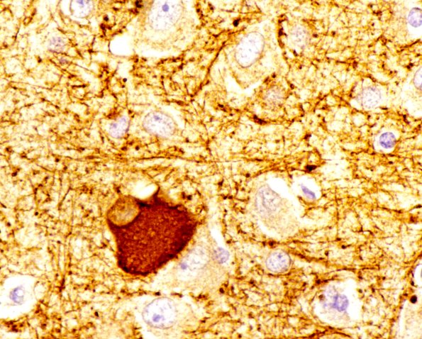 1E9 CBD (Case 1) NF Neuron, balooned, CBD NFil