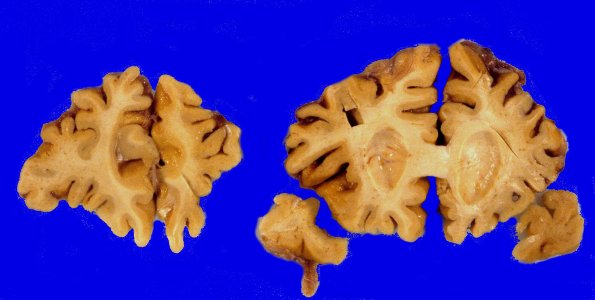 2A2 Corticobasal Degeneration (CBD, Case 2) 5