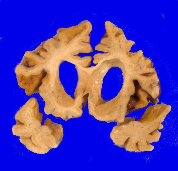 2A3 Corticobasal Degeneration (CBD, Case 2) 9