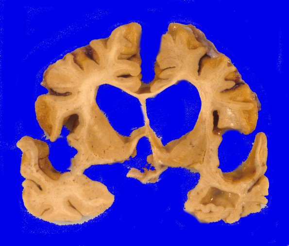 2A4 Corticobasal Degeneration (CBD, Case 2) 7