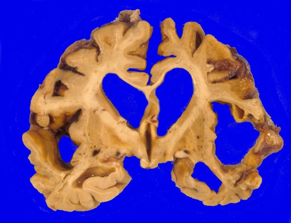 2A5 Corticobasal Degeneration (CBD, Case 2) 4