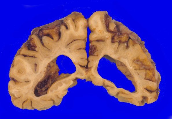 2A6 Corticobasal Degeneration (CBD, Case 2) 2