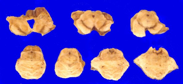 2A7 Corticobasal Degeneration (CBD, Case 2) 3