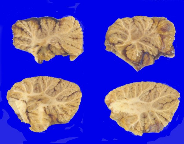 2A8 Corticobasal Degeneration (CBD, Case 2) 1