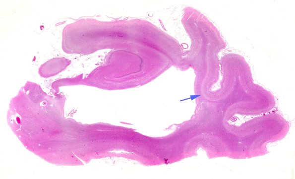 2B1 CBD (Case 2) R5 H&E WM copy