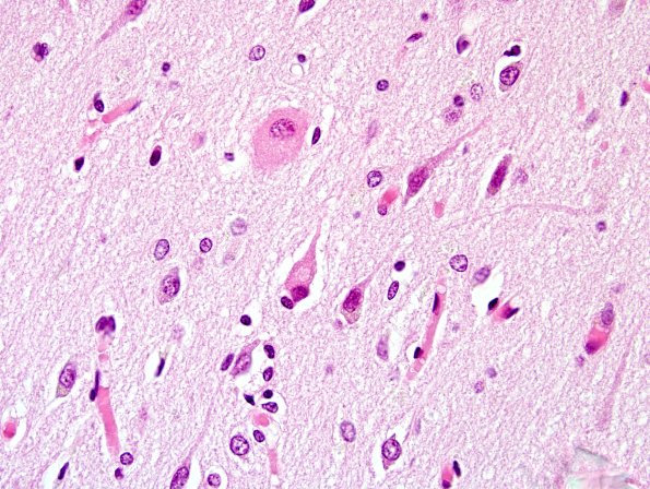 2B9 CBD (Case 2) Cortex H&E 2.jpg