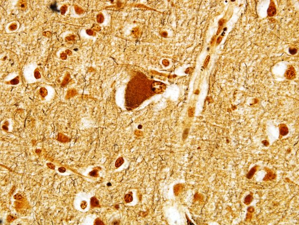 2C4 CBD (Case 2) Cortex Biels 6.jpg