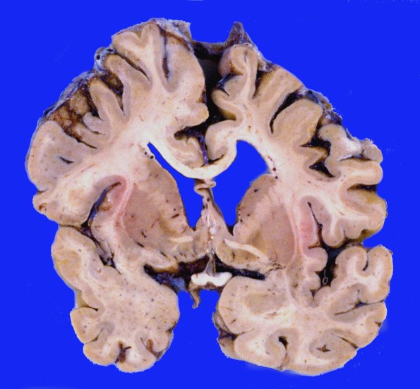 3A3 Corticobasal Degen (Case 3) gross 2