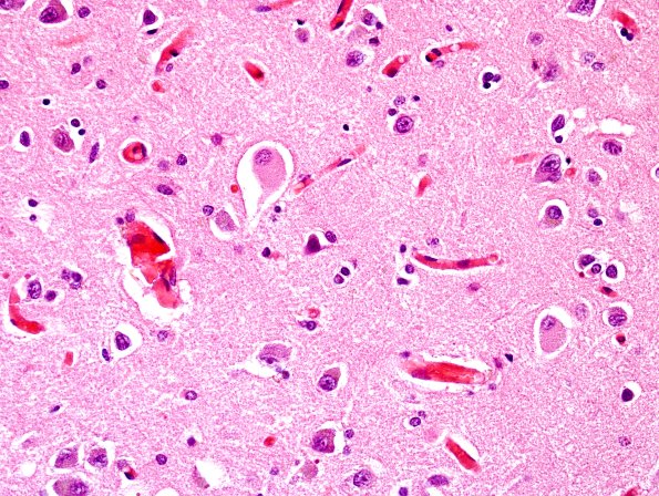 3B8 Corticobasal Degeneration (CBD, Case 3) H&E 1.jpg