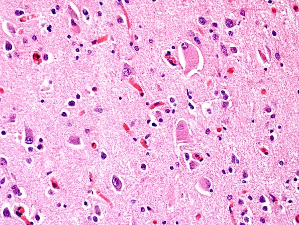 3B9 Corticobasal Degeneration (CBD, Case 3) H&E 3.jpg