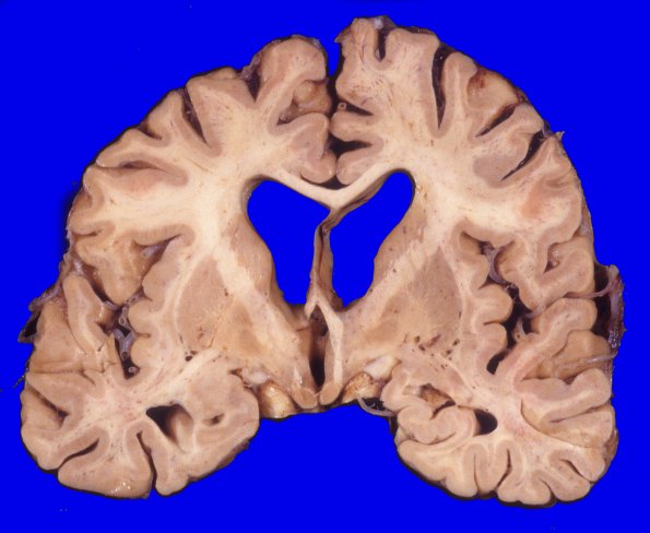 4A3 Corticobasal Degeneration (CBD, Case 4) A1