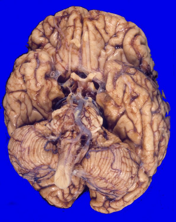 5A1 Corticobasal Degeneration (CBD) L temporal (Case 5) 1