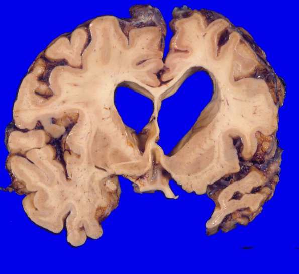 5A2 Corticobasal Degeneration (CBD) (Case 5) 2