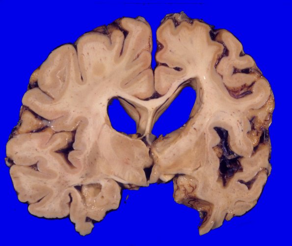 5A3 Corticobasal Degeneration (CBD) (Case 5) 3