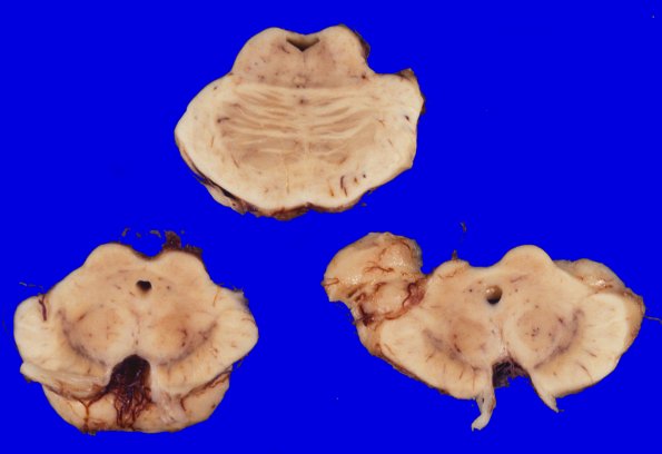 5A4 Corticobasal Degeneration (CBD) (Case 5) 4