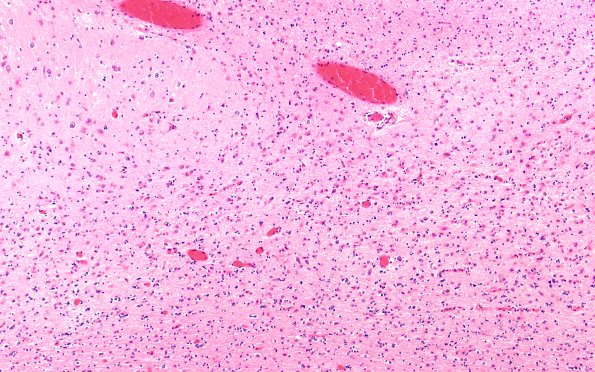 5B3 CBD N8 (Case 5) H&E RHC 10X subiculum